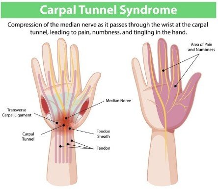 How to Prevent Carpal Tunnel Syndrome While Working in Sector-51, Gurugram?